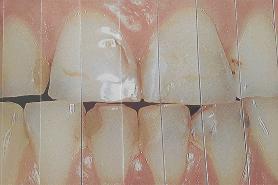 Photo du traitement Les facettes dentaires
