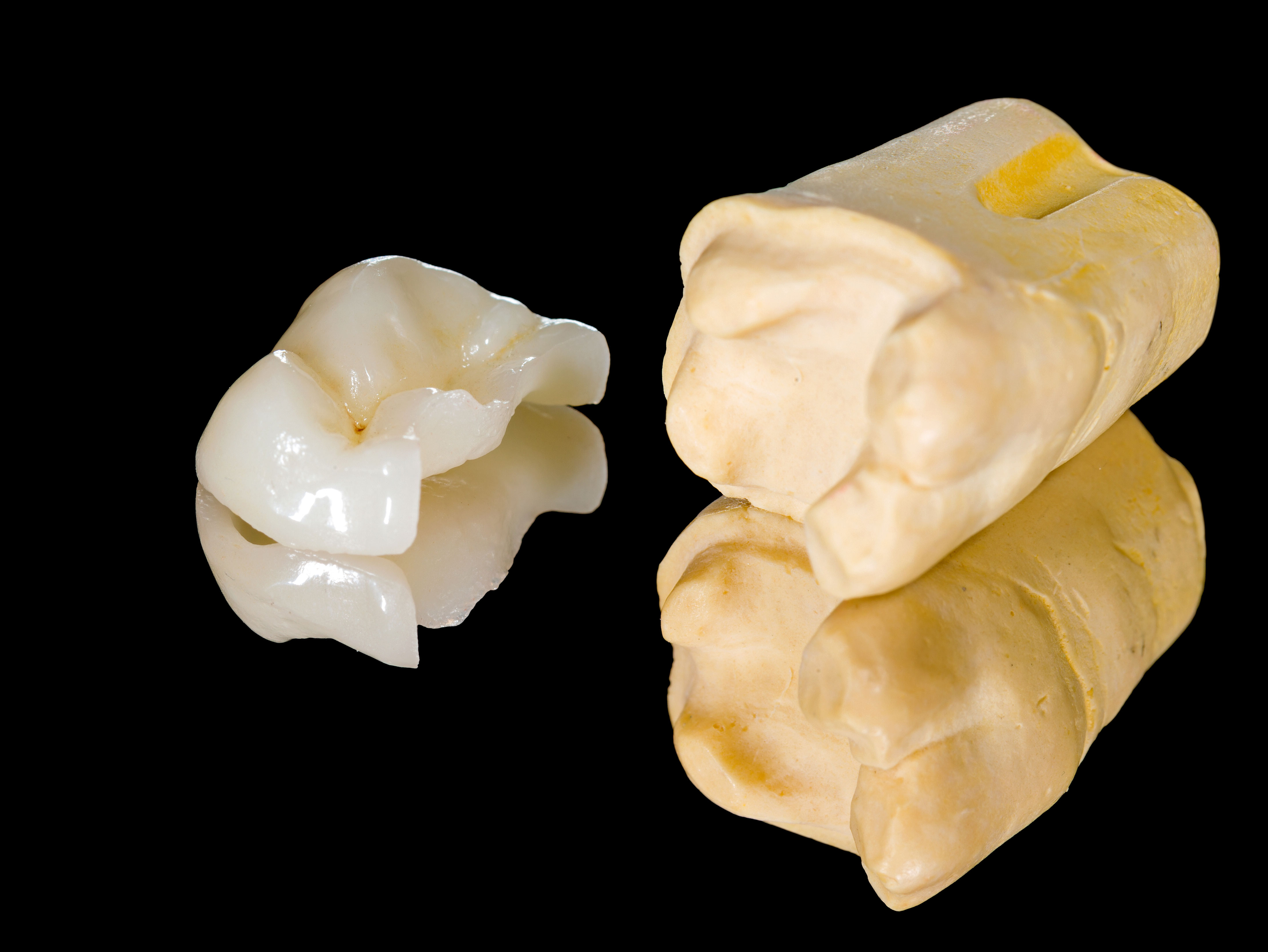 Photo du traitement Les inlays onlays cosmétiques, à l'identique de la dent naturelle