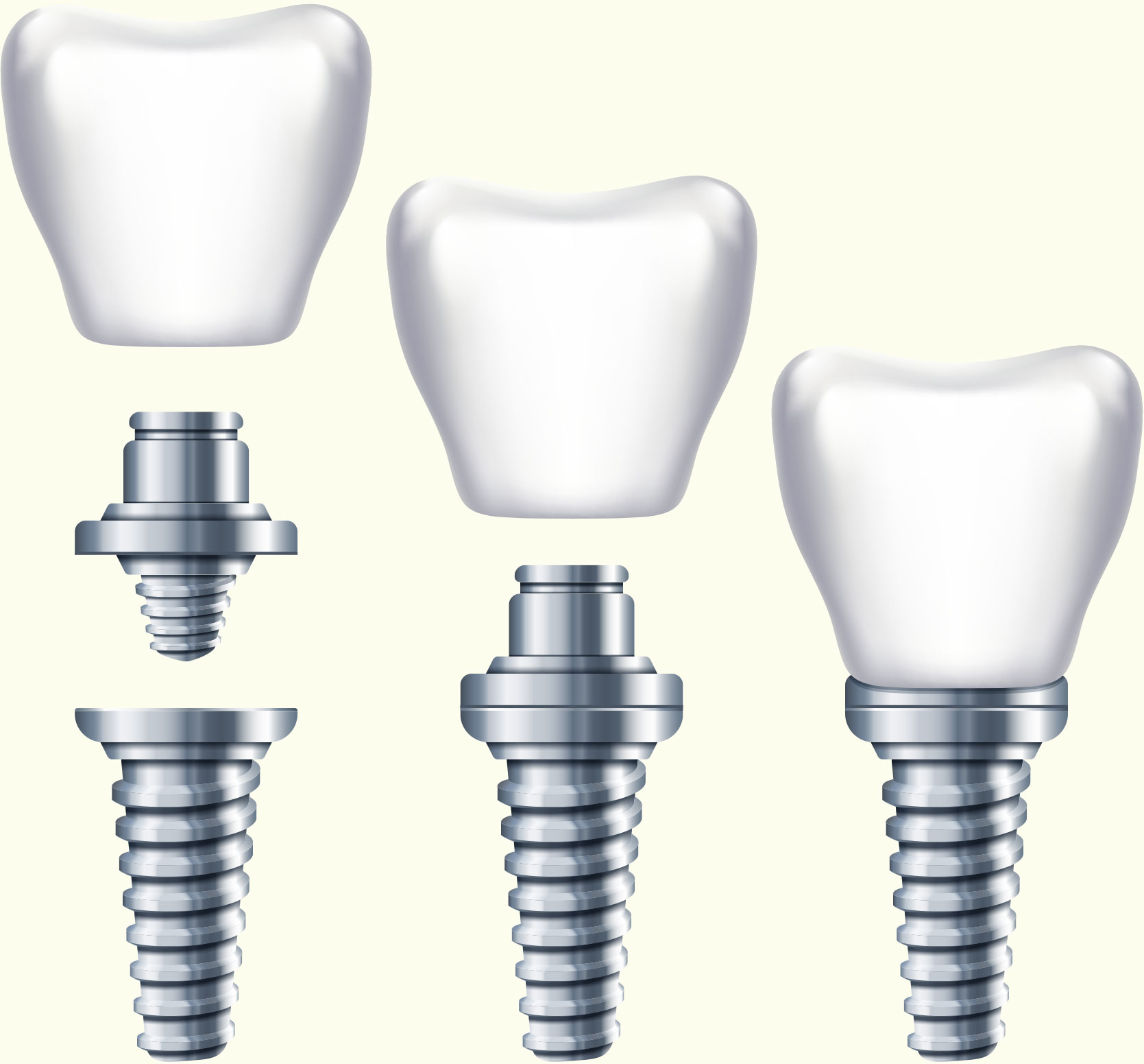 Photo du traitement Les implants et les reconstitutions dentaires sur implants