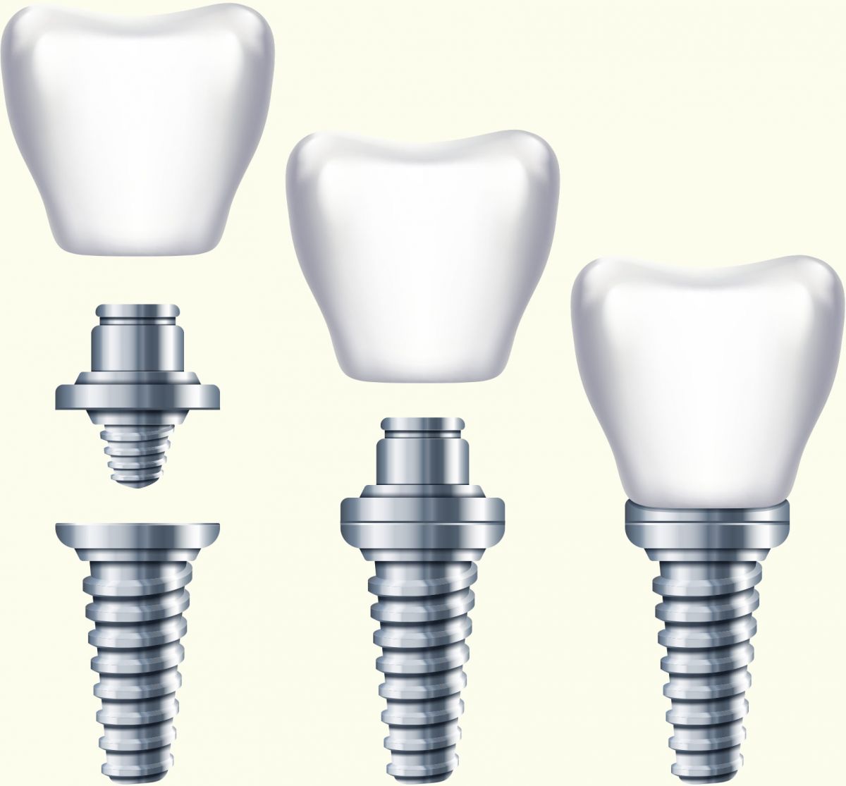 Photo du traitement Les implants et les reconstitutions dentaires sur implants